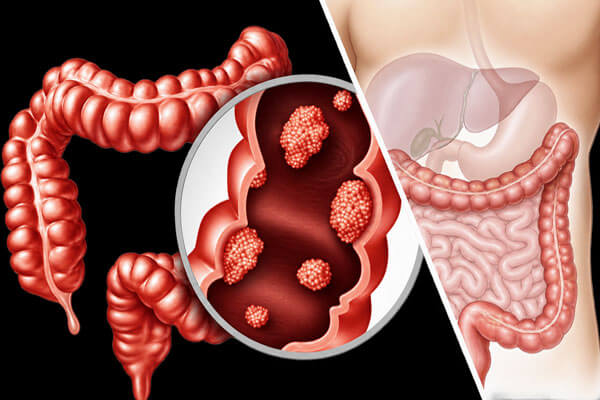 Colorectal Cancer Surgeon in Mahim