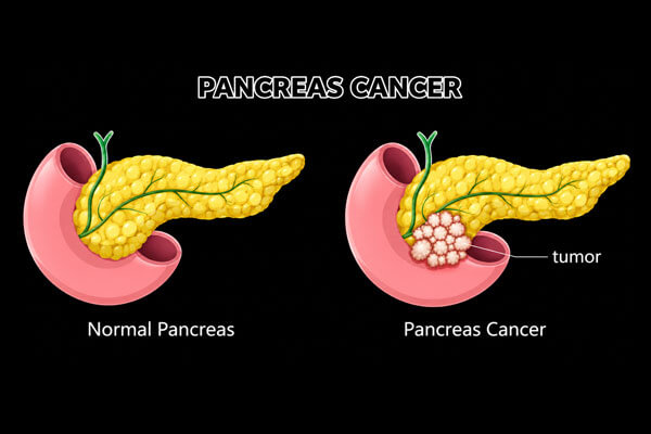 Pancreas Biliary Cancer Surgeon in Mahim