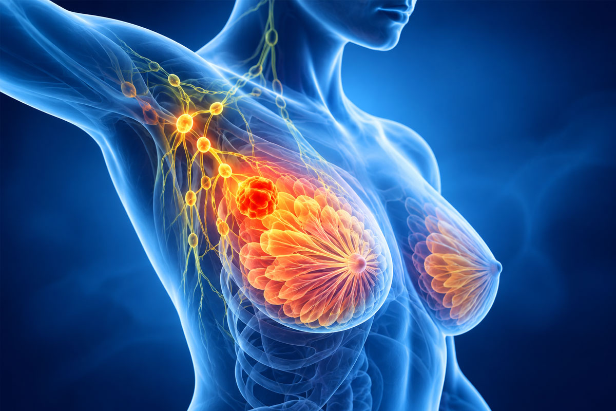 Breast Cancer