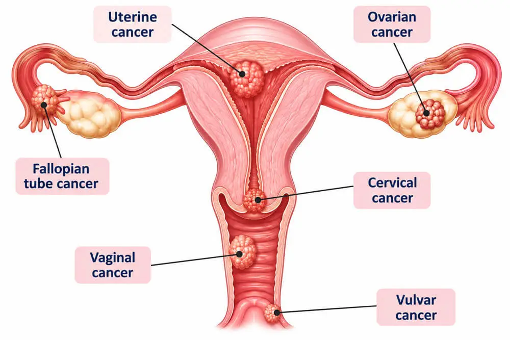 Gynecological Cancer Surgeon