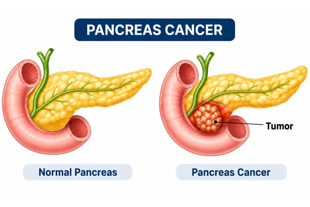 Hepatobiliary Pancreatic Cancer Surgeon